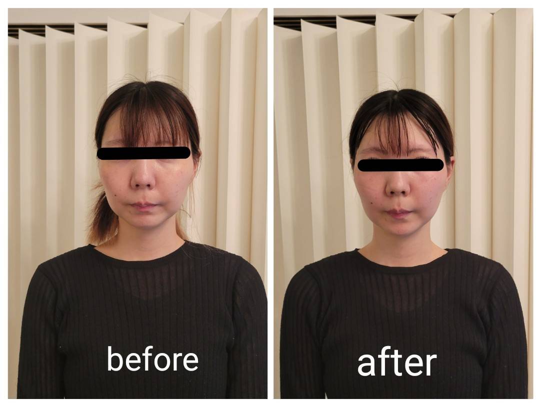 掲載許可をいただいたフェイスラインのビフォーアフター写真その1