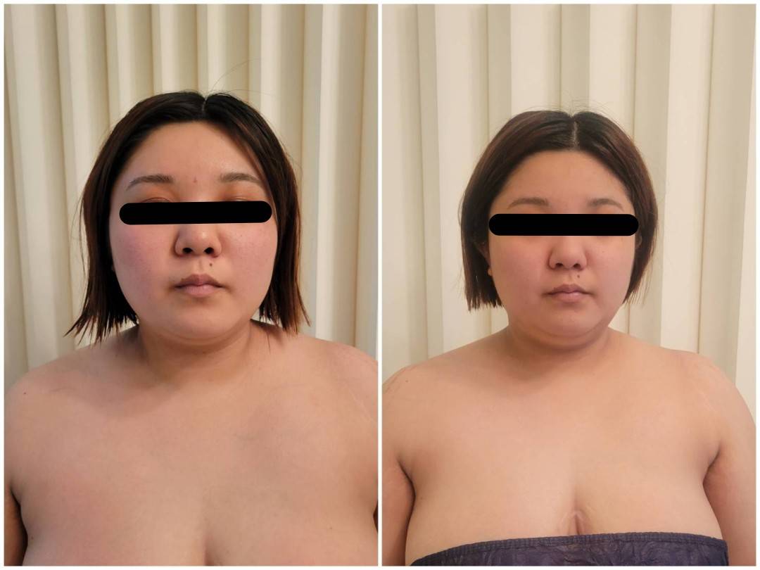 掲載許可をいただいた上半身のビフォーアフター写真